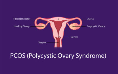 Polycystic Ovarian Syndrome and Gut Health 